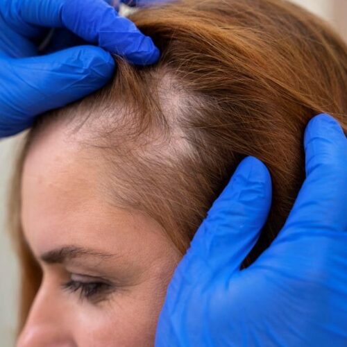 Alopecia - choroba przewlekła